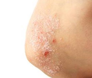 Psoriasis