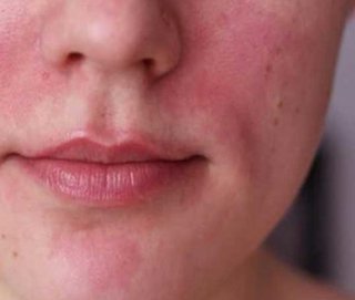 Rosacea